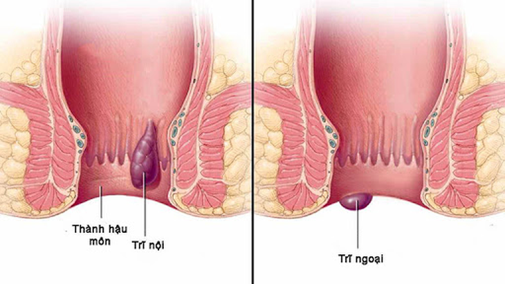 Bệnh trĩ là gì? Dấu hiệu, nguyên nhân và cách khắc phục?