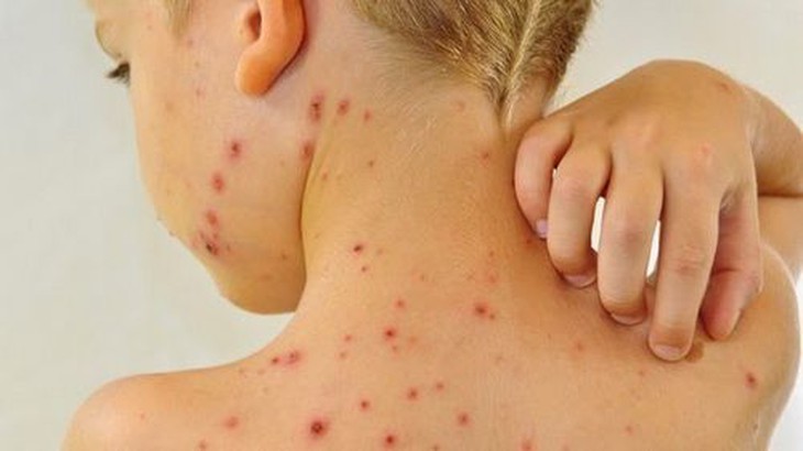 Những biến chứng nguy hiểm của thuỷ đậu mà cộng đồng cần biết