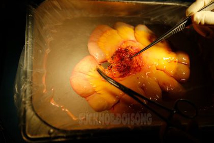Dấu ấn: Việt Nam là nước thứ 20 trên thế giới ghép ruột thành công