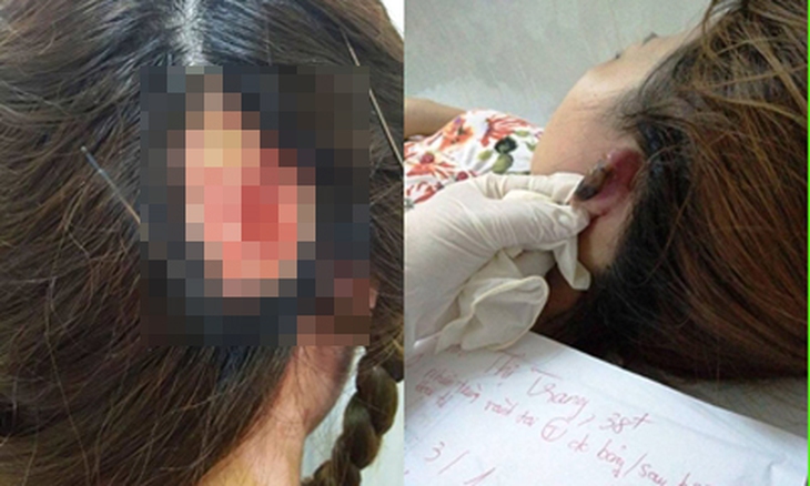mất tai vì làm tóc