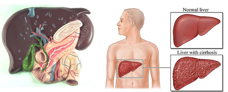 Xơ gan, những điều bạn cần biết