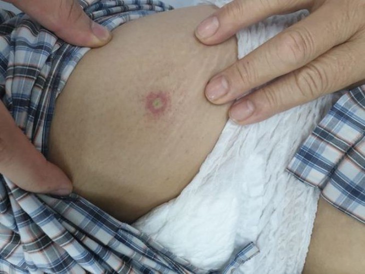 Cảnh báo cấp cứu nguy cơ ngừng tuần hoàn do côn trùng đốt