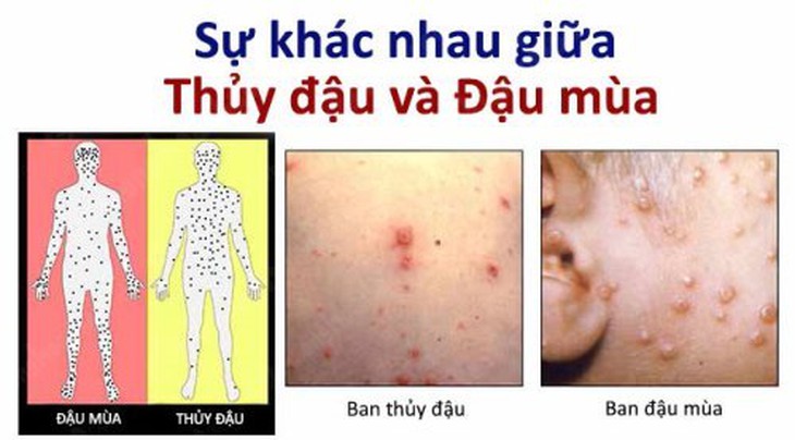 FDA phê duyệt thuốc đầu tiên trị bệnh đậu mùa