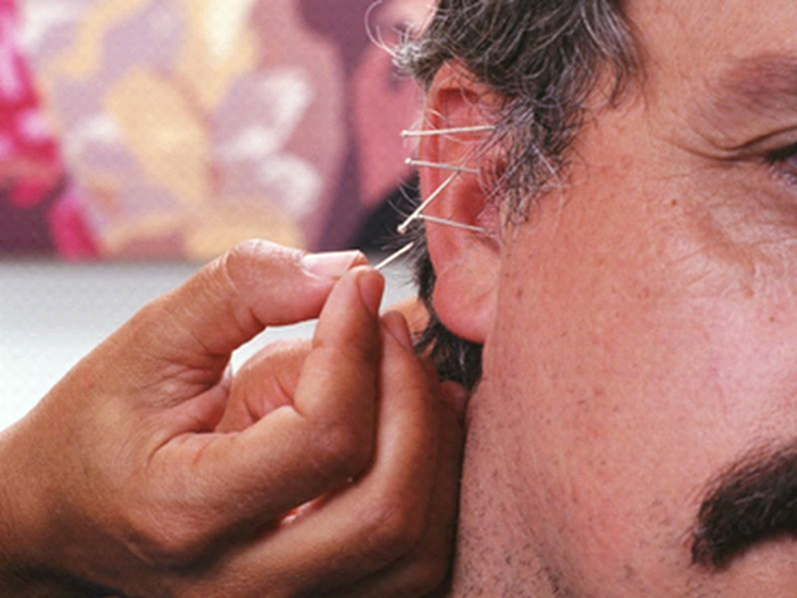 Châm cứu có thể giúp ngăn ngừa chứng đau nửa đầu