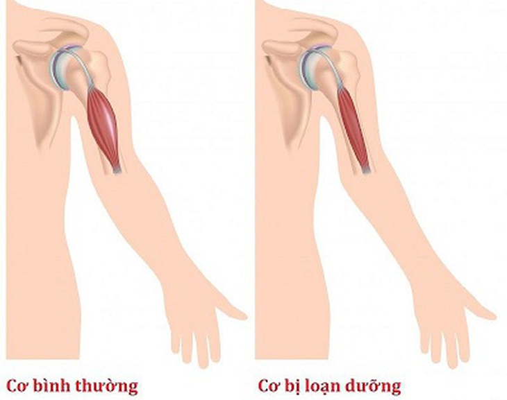 Thuốc mới trị bệnh loạn dưỡng cơ Duchenne do đột biến gen
