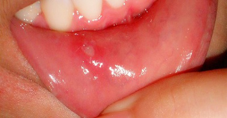 Ứng phó với tình trạng loét miệng