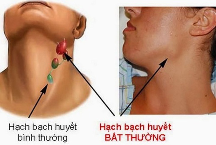 Thuốc mới trị ung thư hạch tái phát, kháng trị: Một số cẩn trọng khi dùng