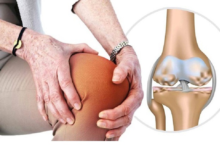 Thoái hóa khớp liên quan đến tăng nguy cơ mắc bệnh Parkinson