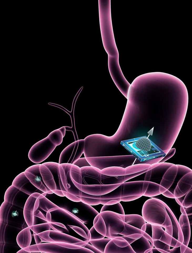 Microchip sử dụng công nghệ ATOMS được định vị trong đường tiêu hoá.