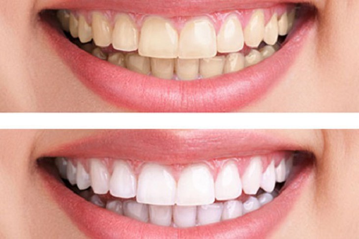Cảnh báo: Có thể bị ung thư lưỡi, ung thư vòm họng khi tẩy trắng răng bằng thuốc tại nhà