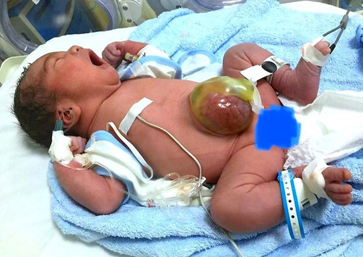 Bé trai bị thoát vị rốn lồi ruột gan ra ngoài được cứu sống, bố mẹ xúc động gủi tâm thư tới y bác sĩ