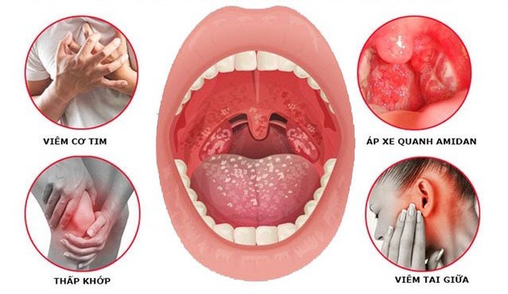 Cách nào cải thiện viêm amidan hốc mủ hiệu quả?