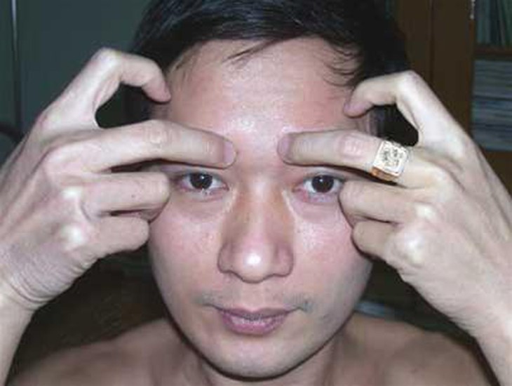Bài thuốc chữa liệt dây thần kinh VII ngoại biên 1