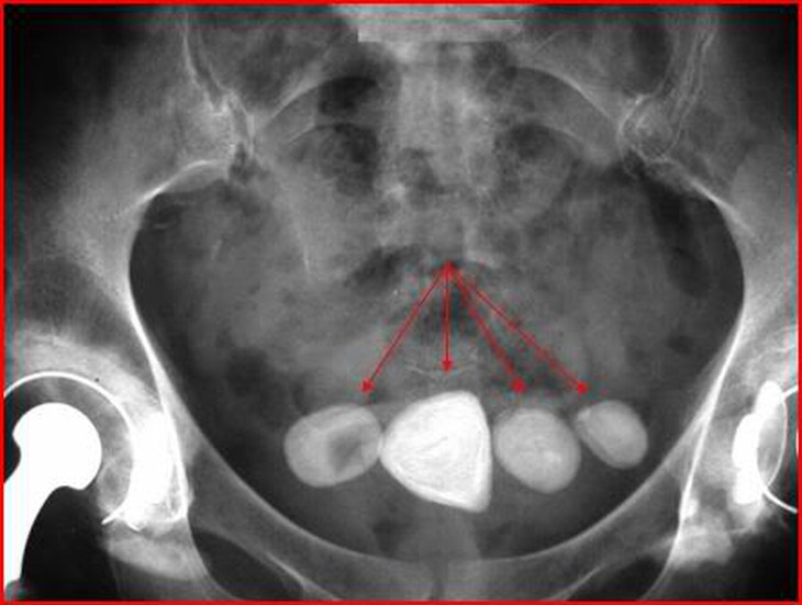 Nhịn tiểu thường xuyên mắc bệnh gì? 1