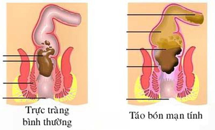 Những hệ lụy do lạm dụng thuốc tẩy trị táo bón 1