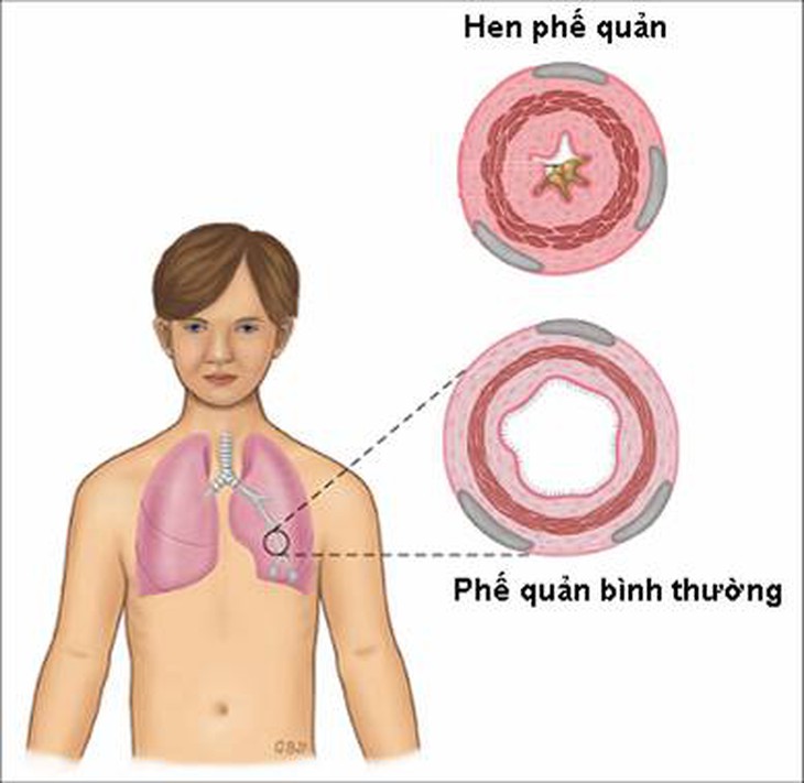 Dự phòng cơn hen phế quản bùng phát khi chuyển mùa 1