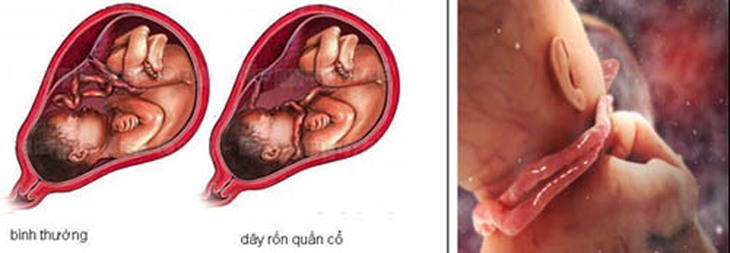 Tràng hoa quấn cổ ở thai nhi 1