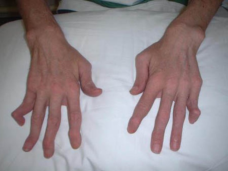 Nguy hiểm do viêm gan tự miễn 1