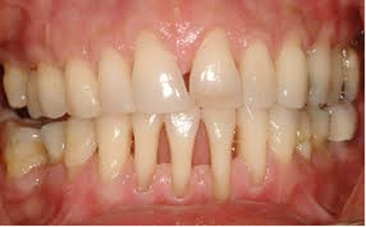 Co lợi, bất lợi cho răng 1