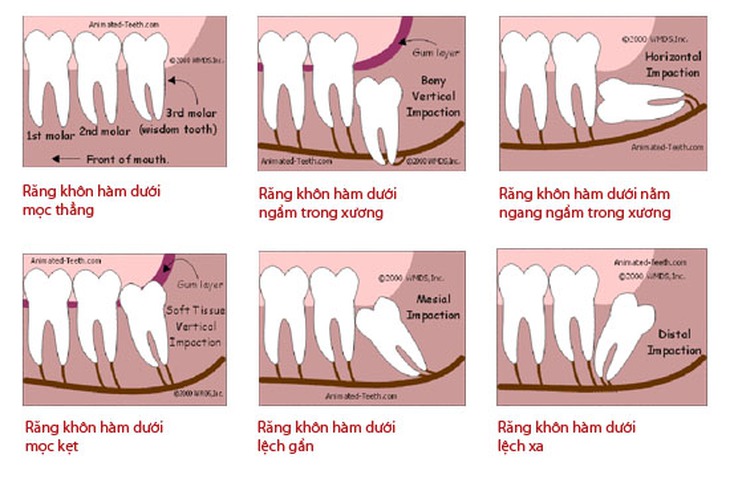 Răng khôn mọc kẹt 1