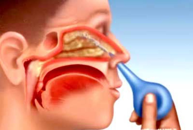 Thuốc xịt mũi: Dùng không dễ! 1