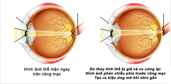 Lão thị: Sử dụng kính thế nào cho đúng? 1