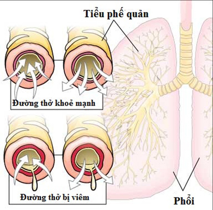 Ngừa hen phế quản ở thai phụ 1