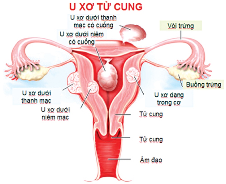 U xơ tử cung có nguy hiểm? 1