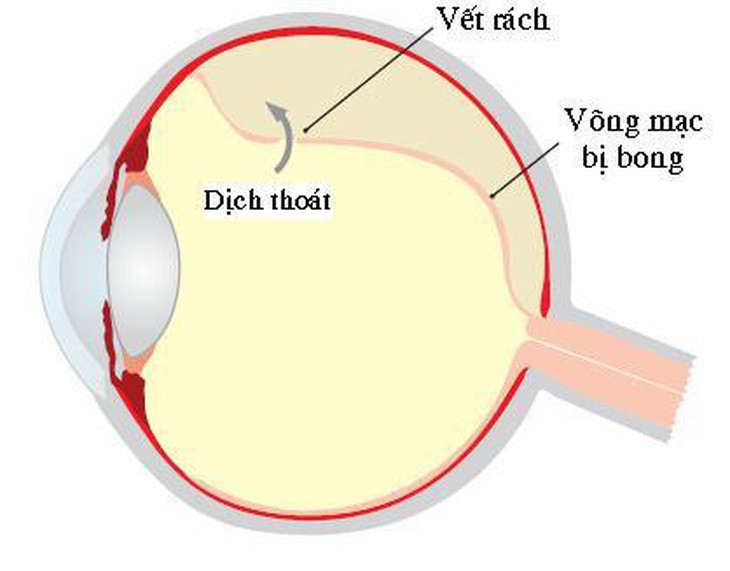 Phát hiện sớm nguy cơ bong võng mạc gây mù 1