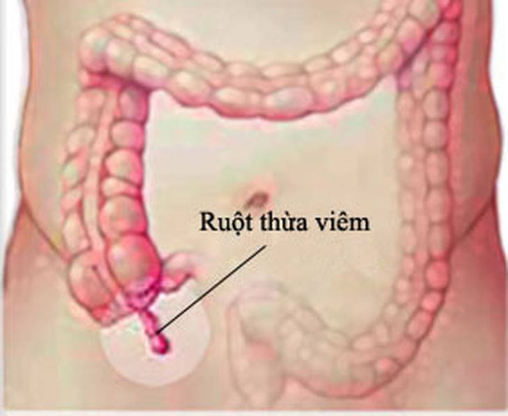 Cảnh giác với biến chứng viêm ruột thừa cấp 2