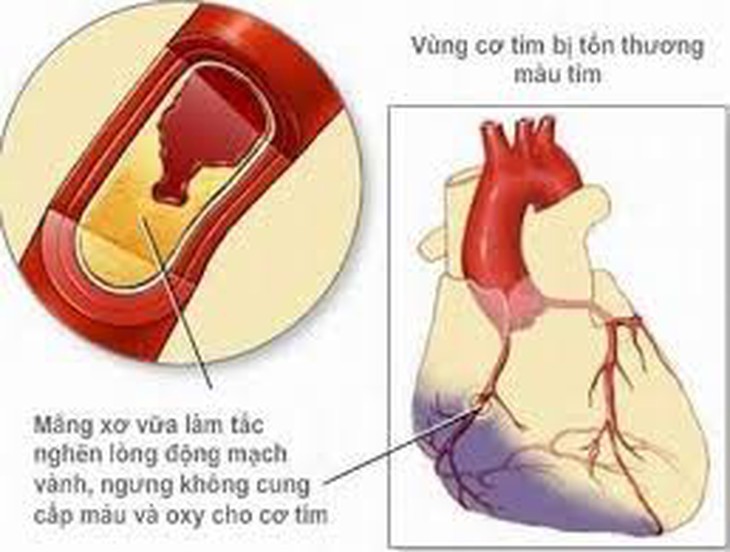 Các nhóm thuốc điều trị nhồi máu cơ tim 1