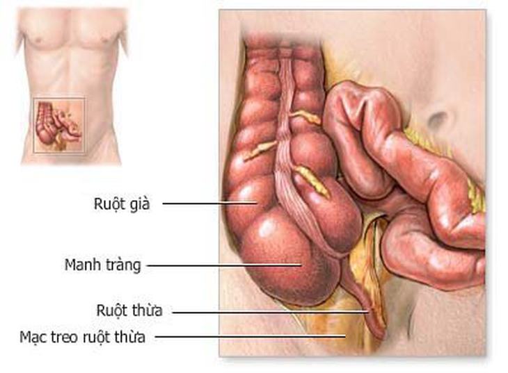 Cảnh giác với biến chứng viêm ruột thừa cấp 1
