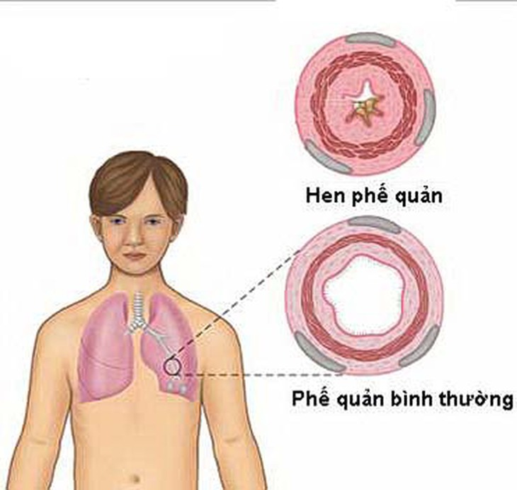 Sử dụng an toàn thuốc kháng viêm giảm đau 1