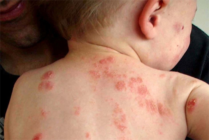 Một số bệnh da hay gặp trong mùa hè và thuốc trị 1