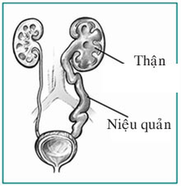 Đừng lo khi mắc thận ứ nước 1
