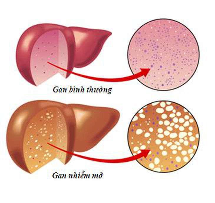 Gan nhiễm mỡ - Phải chặn từ gốc 1