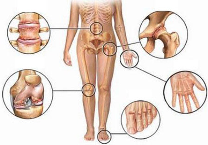 Lưu ý khi chữa viêm khớp tự phát ở trẻ 1