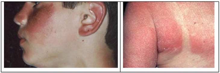 Những trẻ không được dùng corticoid 1