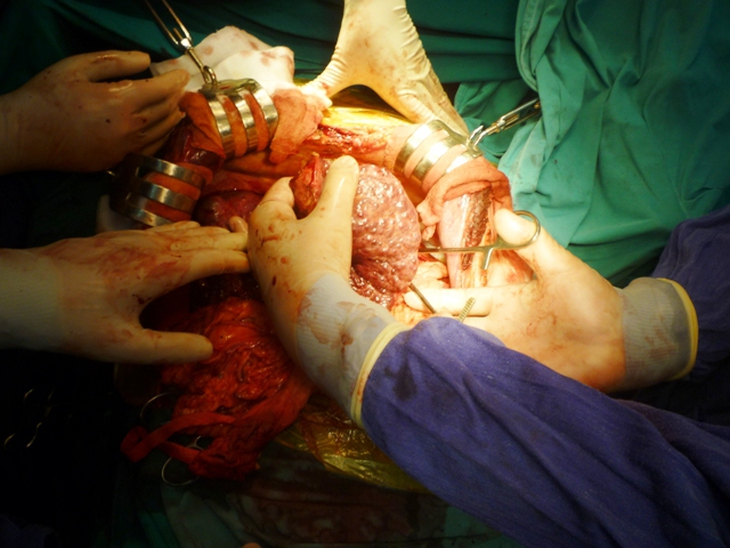 Ghép gan, thận cứu sống ba bệnh nhân hiểm nghèo 3