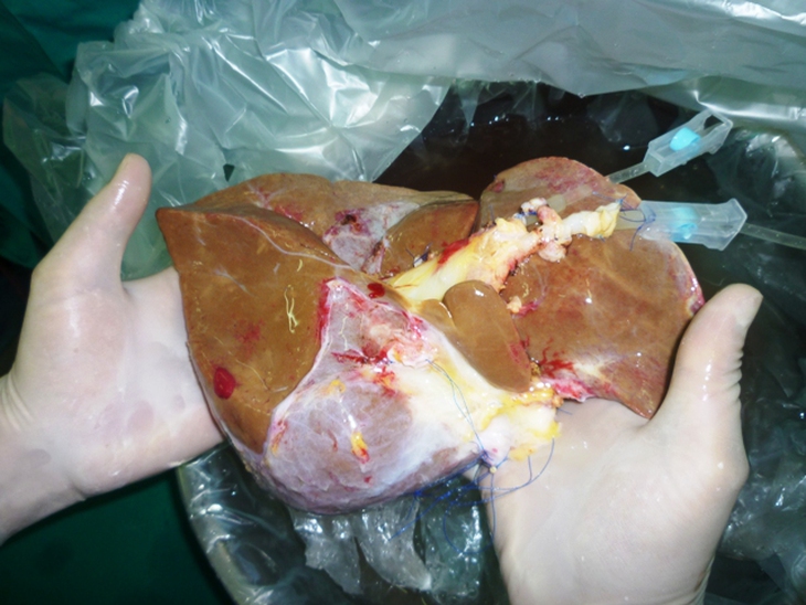 Ghép gan, thận cứu sống ba bệnh nhân hiểm nghèo 6