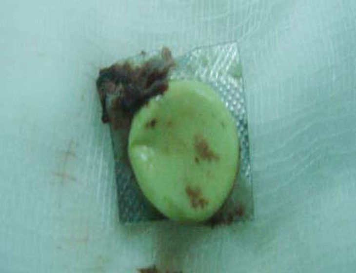 Suy kiệt, nôn ra máu vì uống thuốc còn vỏ 1