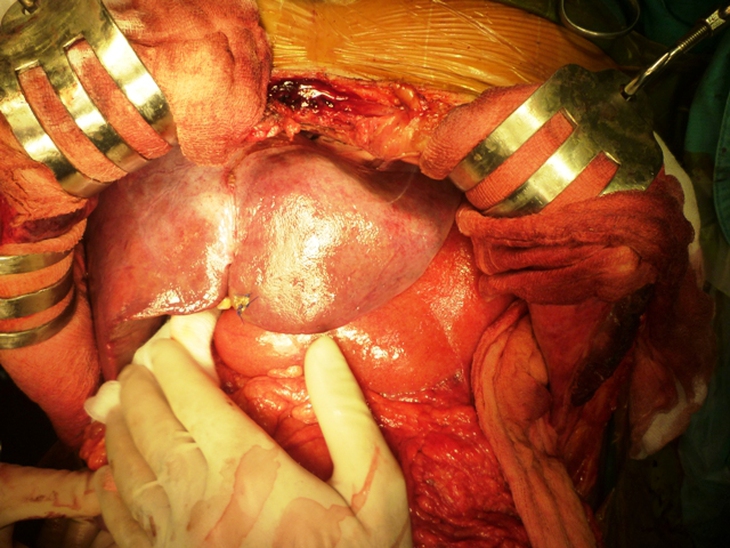 Ghép gan, thận cứu sống ba bệnh nhân hiểm nghèo 7