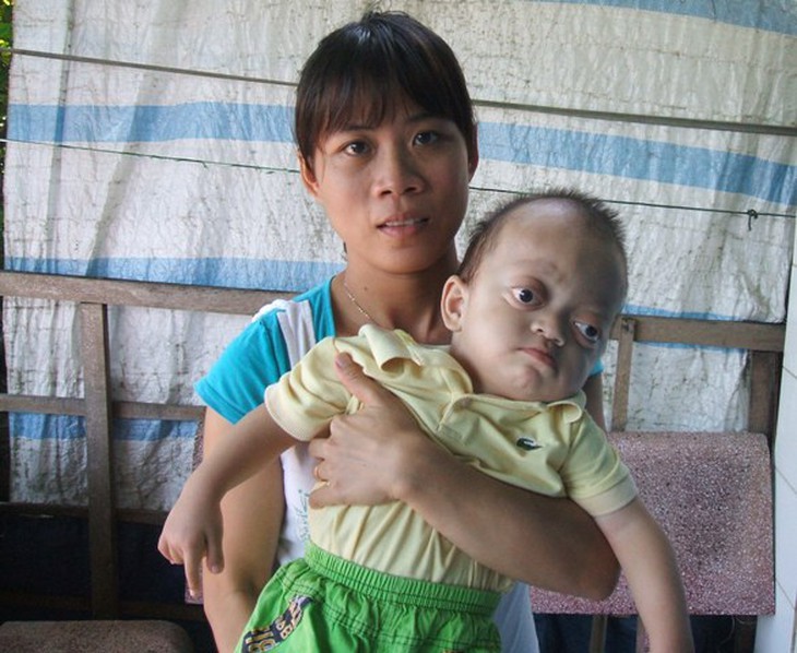 Cứu bé mắc bệnh “lồi mắt” hiếm gặp 1