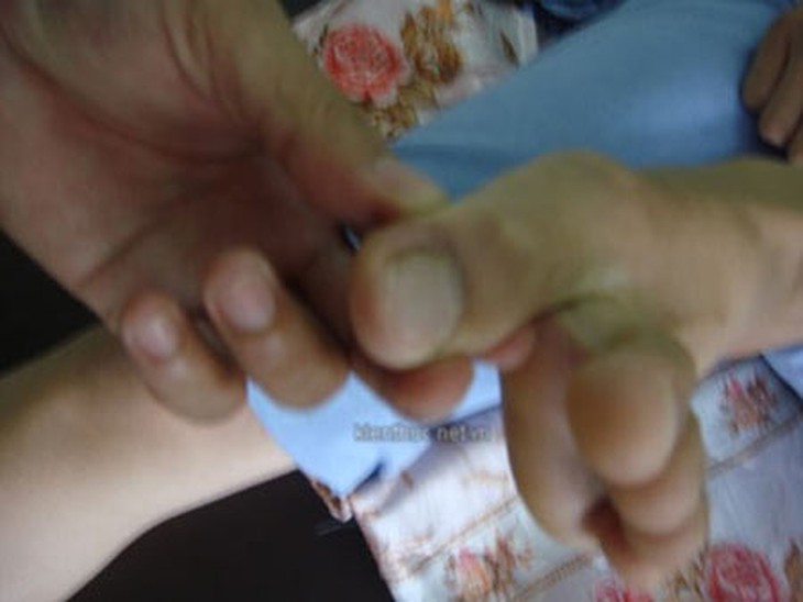 Những ca bệnh hy hữu do bất cẩn trong năm 2012 1