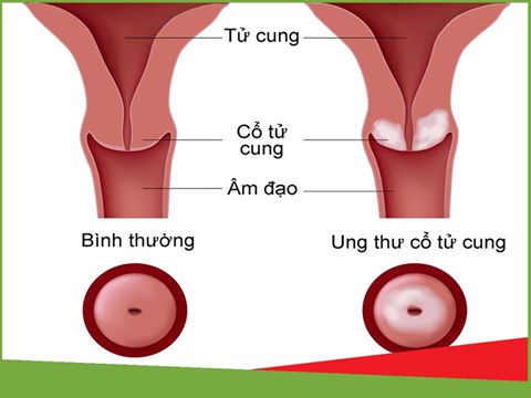 10. Cách Phòng Ngừa Bệnh Phụ Khoa