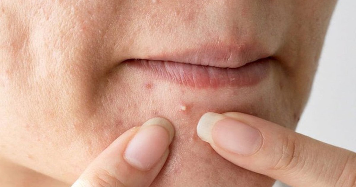 Một nhánh đặc biệt của Psychodermatology: khi hành vi tâm lý trực tiếp tạo tổn thương da