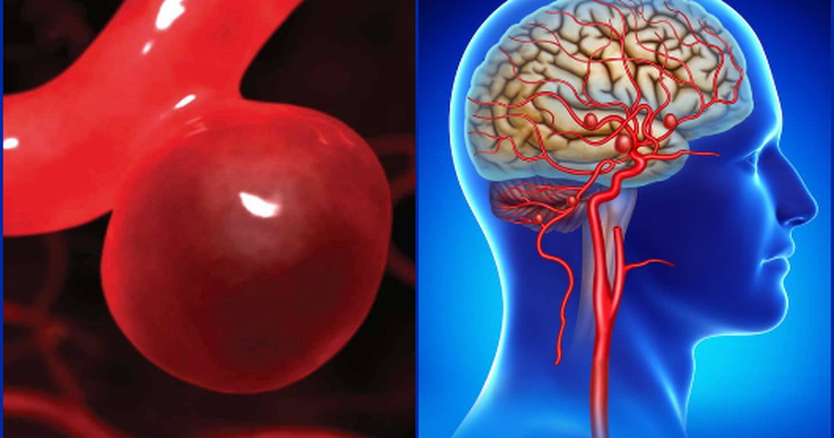 Phình động mạch não có nguy hiểm không?
