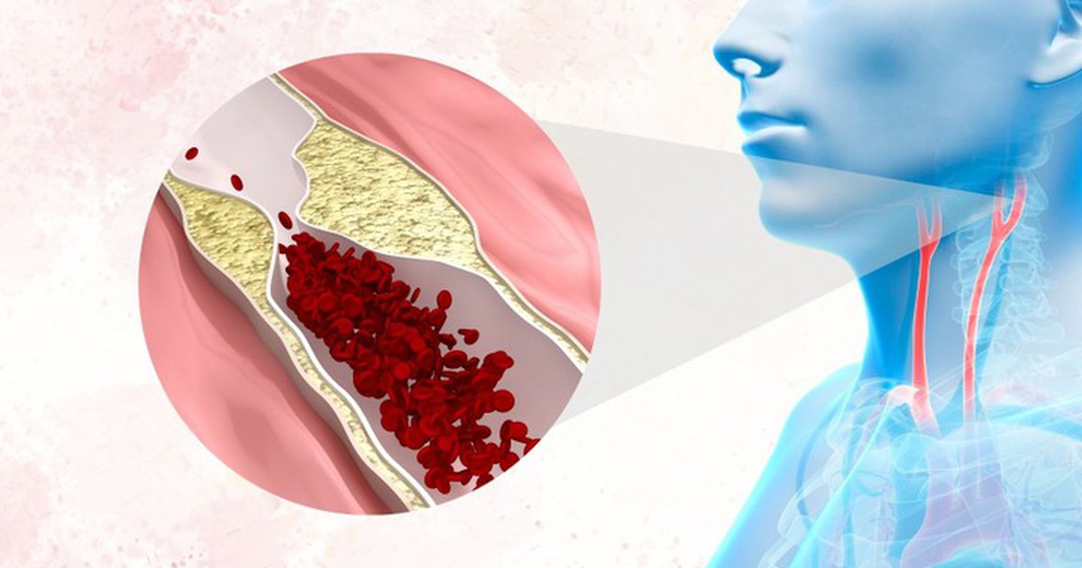 Hẹp động mạch cảnh có thể âm thầm báo trước một cơn đột quỵ