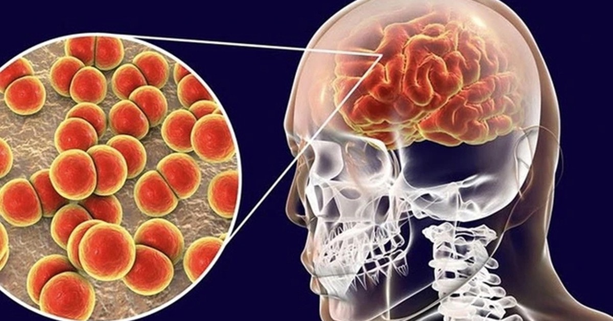 Bệnh não mô cầu nguy hiểm thế nào, phòng bệnh ra sao?