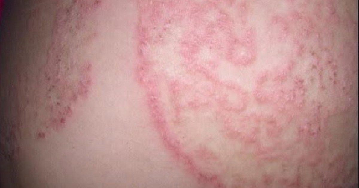5 nguyên tắc quan trọng giúp phòng ngừa nấm da